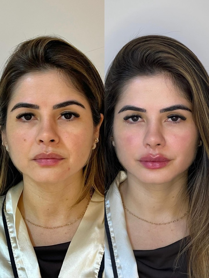 Resultado real do Protocolo Harmonie — antes e depois